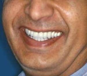 crowns after
