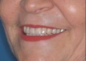 full mouth denture after