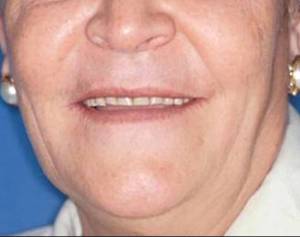 full mouth denture before
