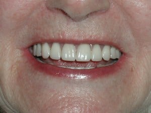 implant overdenture after