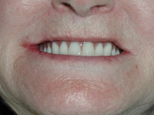 implant overdenture before