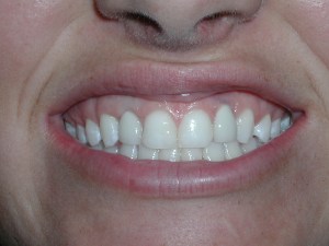implants after