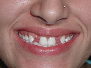 dental implants before