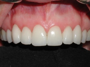 veneers after