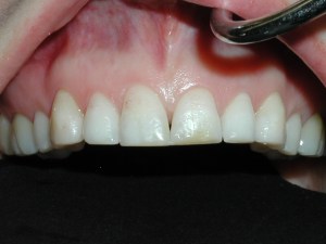 veneers before