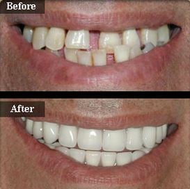 full mouth reconstruction